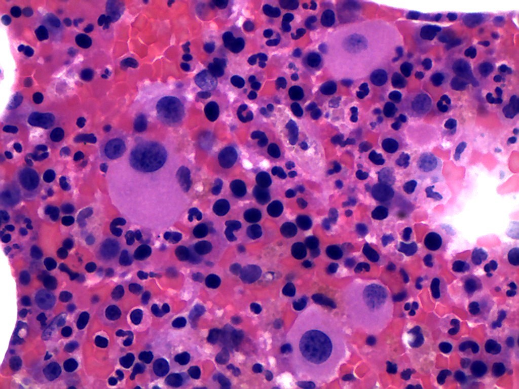 Figure 2: Increased small megakaryocytes with hypolobated nuclei